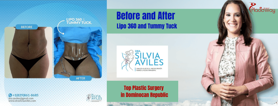 Lipo 360 & Tummy Tuck in Dominican Republic Before & After Images at Dra. Silvia Aviles