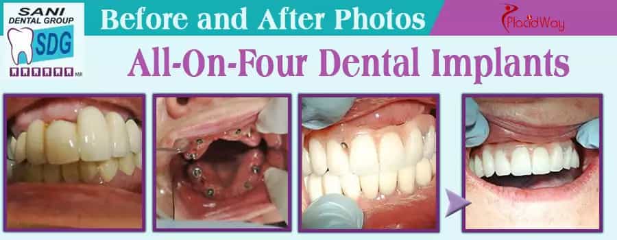 Before and after pictures of all on 4 dental implants in Mexico