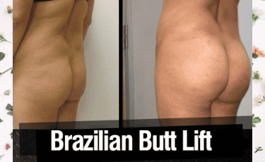 Cirugía Plástica en Reynosa México por Hospital Los Lagos