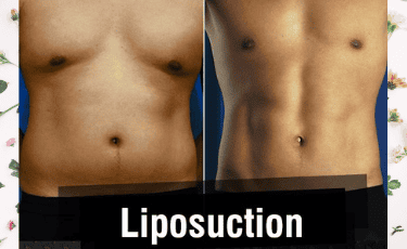 Cirugía Plástica en Reynosa México por Hospital Los Lagos