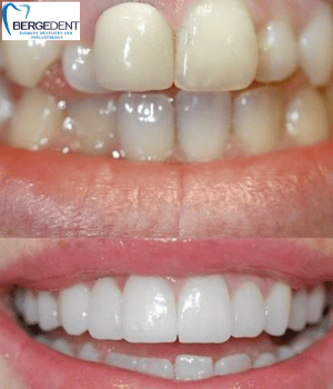 Restauración completa de la corona