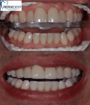 Blanqueamiento dental