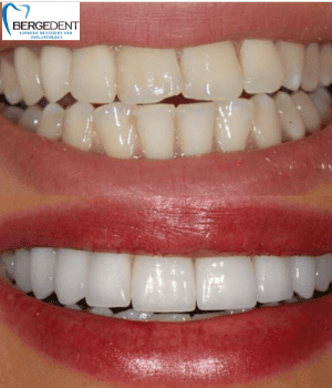 Cerámica de zirconio