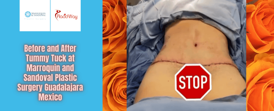 Abdominoplastia antes y después en Marroquín y Sandoval Plastic Surgery Guadalajara México