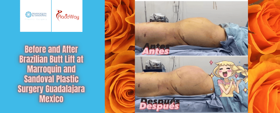 Levantamiento de Glúteos Brasileño en Marroquín y Sandoval Plastic Surgery Guadalajara México
