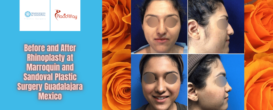 Rinoplastia en Cirugía Plástica Marroquín y Sandoval Guadalajara México