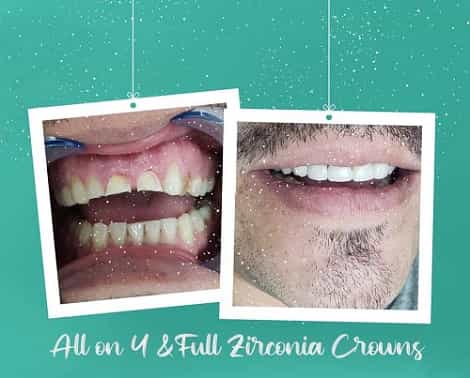 Dental Implant in Los Algodones Mexico by Navarro