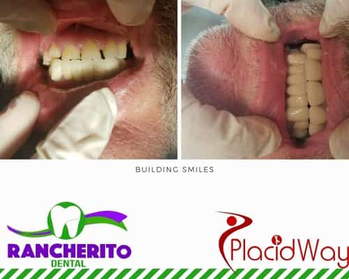 Tratamiento dental antes y después en Los Algodones México por Rancherito Dental