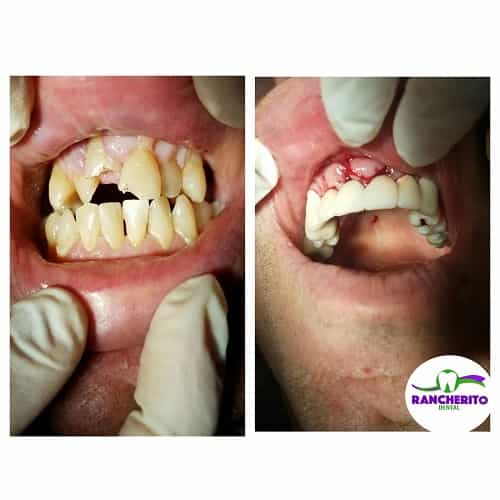 Tratamiento dental antes y después en Los Algodones México por Rancherito Dental