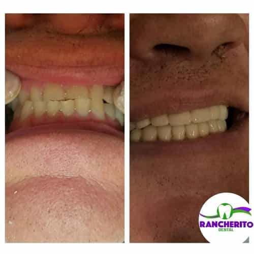 Tratamiento dental antes y después en Los Algodones México por Rancherito Dental