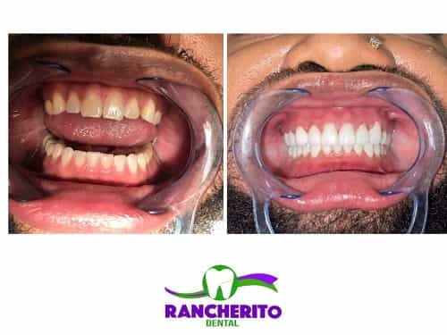 Tratamiento dental antes y después en Los Algodones México por Rancherito Dental