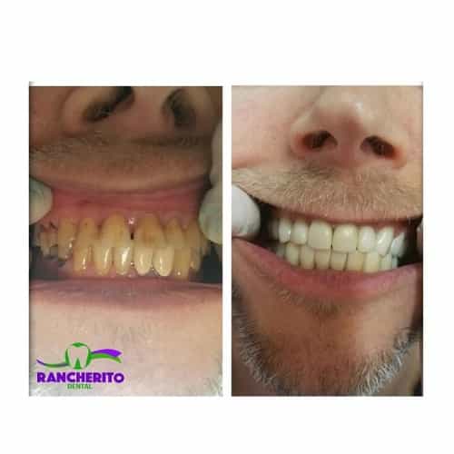 Tratamiento dental antes y después en Los Algodones México por Rancherito Dental