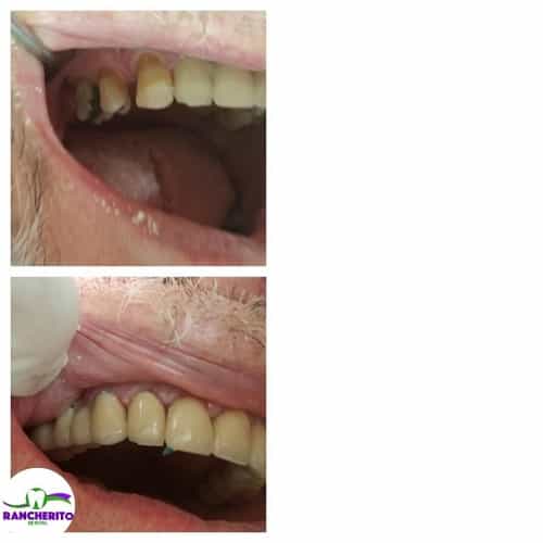 Tratamiento dental antes y después en Los Algodones México por Rancherito Dental