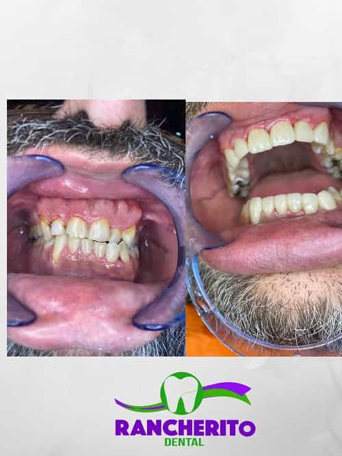 Tratamiento Dental en Los Algodones México