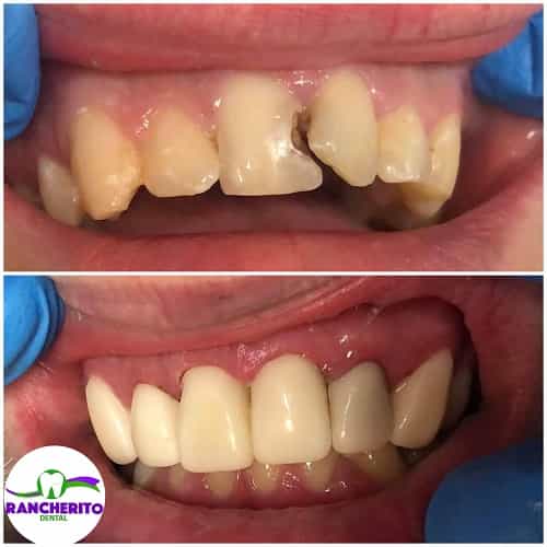 Tratamiento Dental en Los Algodones México