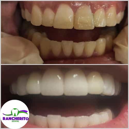 Tratamiento Dental en Los Algodones México