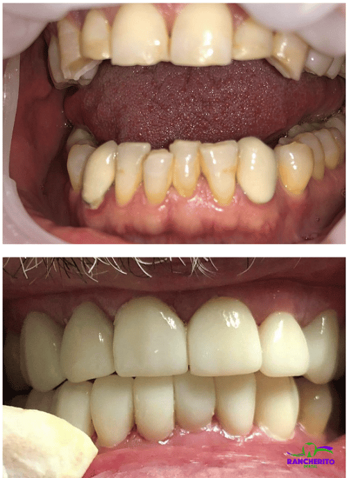Rehabilitación Oral Completa | Rancherito Dental