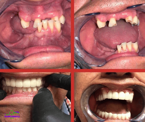 Rehabilitación Oral Completa | Rancherito Dental