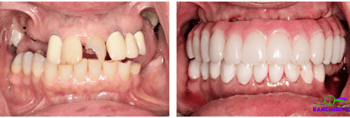 Barra fija de circonio All-On-Four