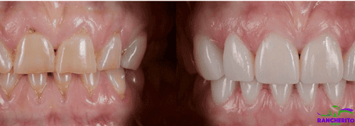 Carillas de composite | Rancherito Dental