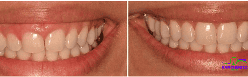 Alargamiento de Corona | Rancherito Dental