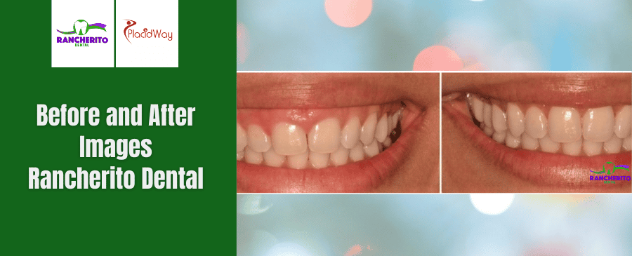 Antes y Después de Corona Dental en Los Algodones, México