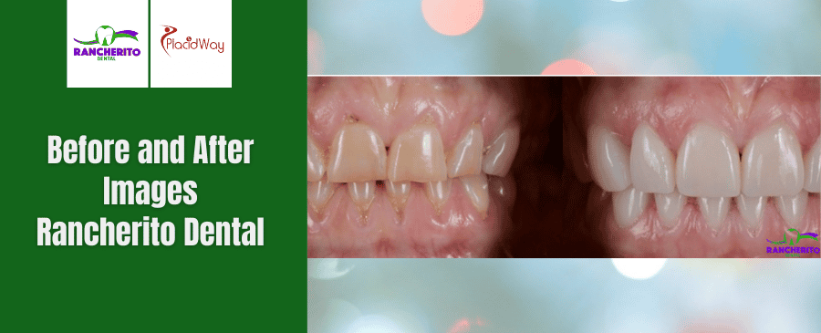 Antes y Después de Corona Dental en Los Algodones, México