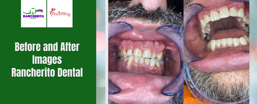 Antes y Después de Corona Dental en Los Algodones, México