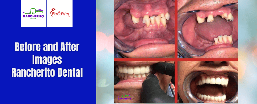Antes y Después de una Rehabilitación Oral Completa en Los Algodones, México