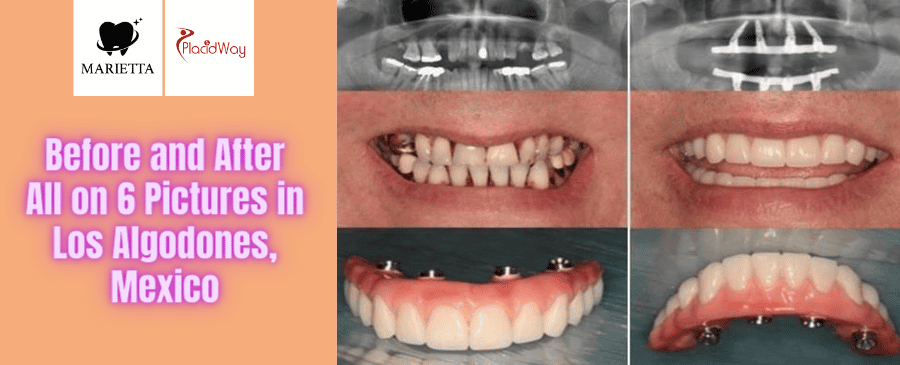 Antes y Después de Todo sobre 6 Implantes Dentales en Los Algodones, México