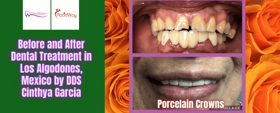 Fotografías de antes y después de un tratamiento dental en Los Algodones, México, por la Dra. Cinthya García