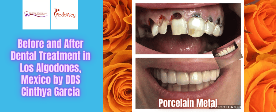 Fotografías de antes y después de un tratamiento dental en Los Algodones, México, por la Dra. Cinthya García