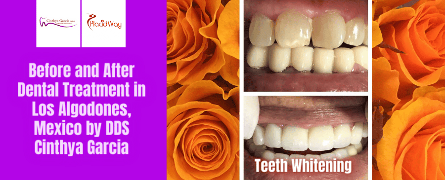 Fotografías de antes y después de un tratamiento dental en Los Algodones, México, por la Dra. Cinthya García