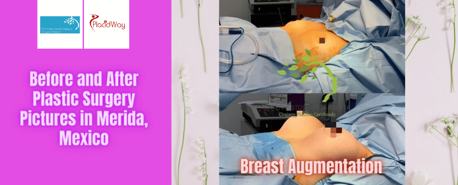 Fotografías de antes y después de cirugía plástica en Mérida, México