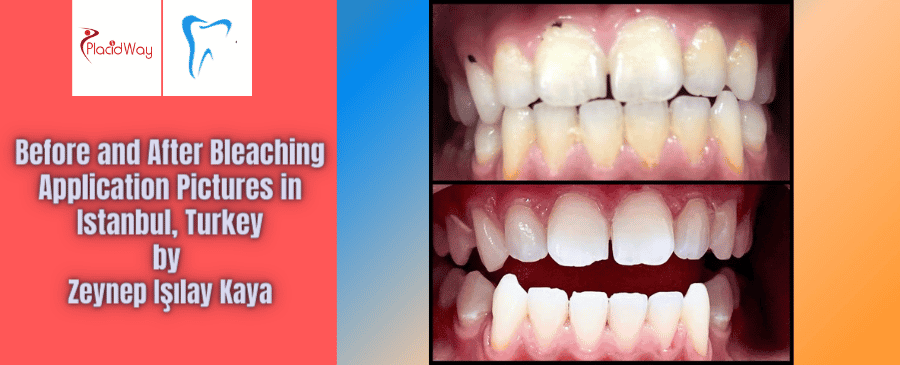 Antes y después de la aplicación de blanqueamiento