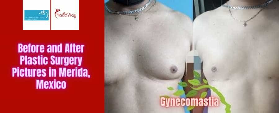 Dr. Ernesto Javier Acosta Abeyta Antes y Después