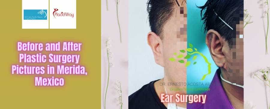 Dr. Ernesto Javier Acosta Abeyta Antes y Después