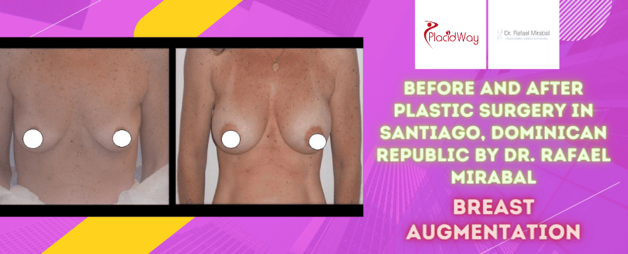 Before and After Breast Augmentation Surgery in Santiago, Dominican Republic by Dr. Rafael Mirabal