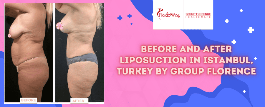 Liposucción antes y después en Estambul, Turquía, por el Grupo Florence