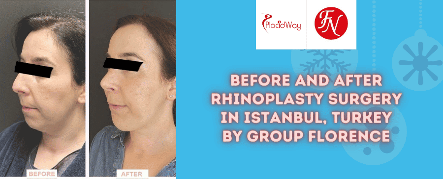 Paquete de rinoplastia antes y después en Estambul, Turquía, a cargo del Grupo Florence