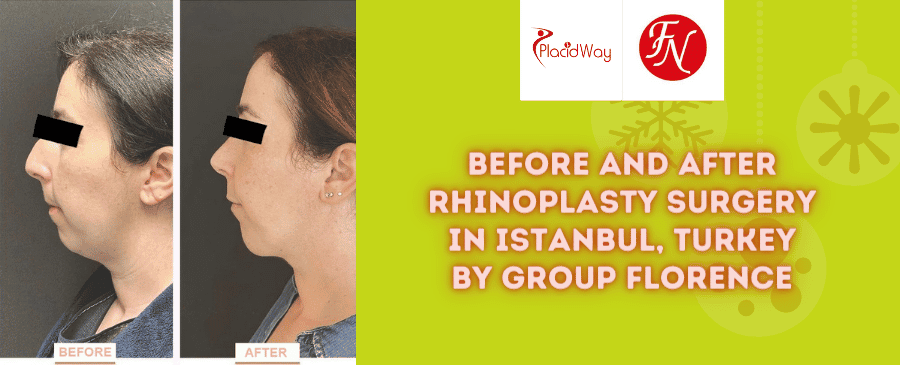 Paquete de rinoplastia antes y después en Estambul, Turquía, a cargo del Grupo Florence