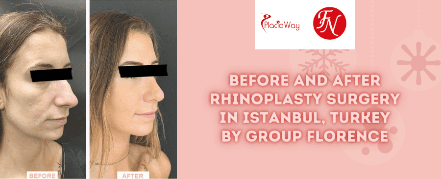 Paquete de rinoplastia antes y después en Estambul, Turquía, a cargo del Grupo Florence