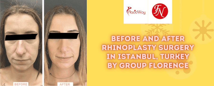 Paquete de rinoplastia antes y después en Estambul, Turquía, a cargo del Grupo Florence