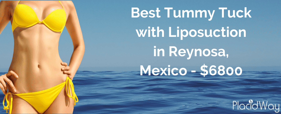 Tummy Tuck in Mexico with Liposuction