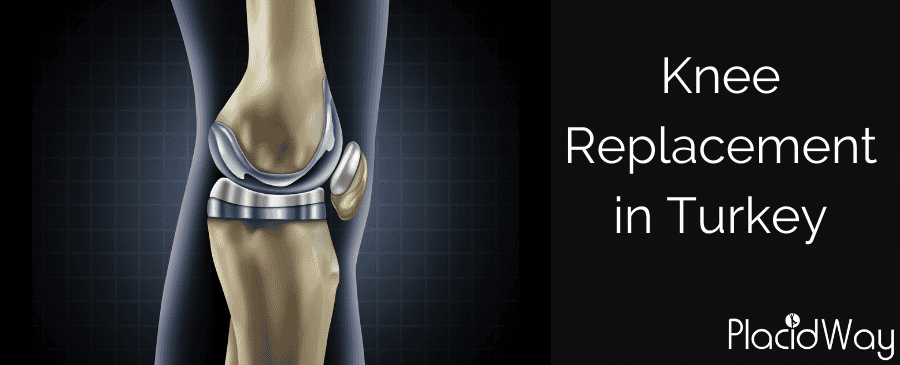A graphic showing a prosthetic knee joint