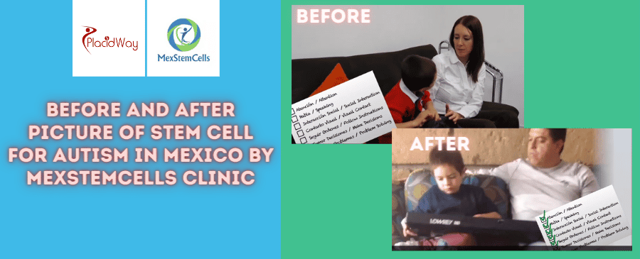 Before and After Picture of Child Stem Cell Treatment in Mexico City Before and After Picture of Child Stem Cell Treatment in Mexico City