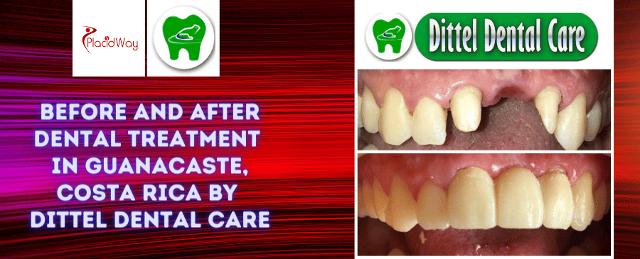 Fotos de antes y después de tratamientos dentales en Guanacaste, Costa Rica