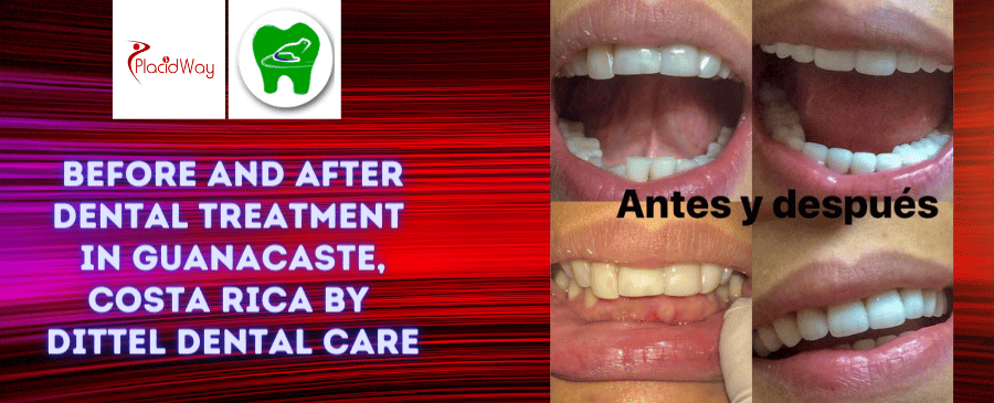 Fotos de antes y después de tratamientos dentales en Guanacaste, Costa Rica