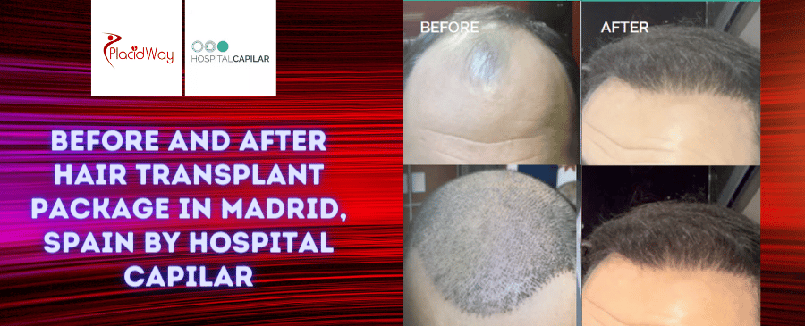 Paquete de trasplante de cabello FUE DHI antes y después en Madrid, España, por Hospital Capilar