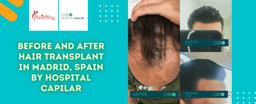 Cirugía de trasplante capilar antes y después en Madrid, España, por Hospital Capilar